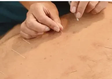 Pain Control Acupuncture