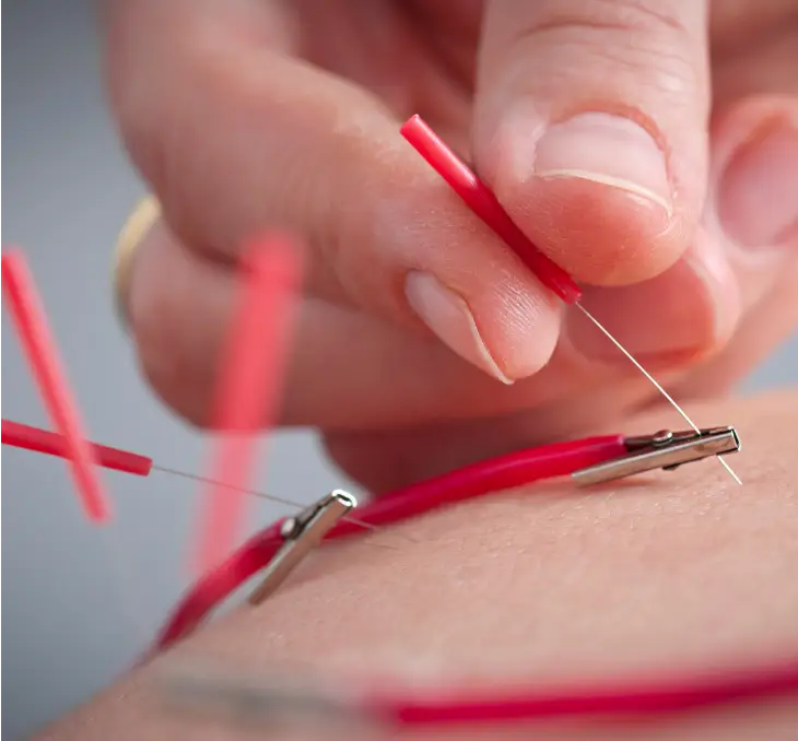 Electroacupuncture