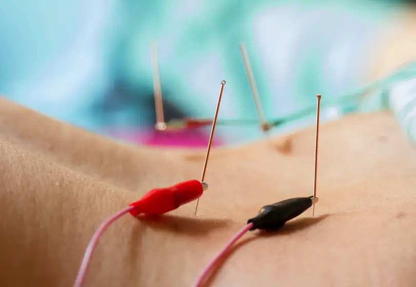 Electroacupuncture