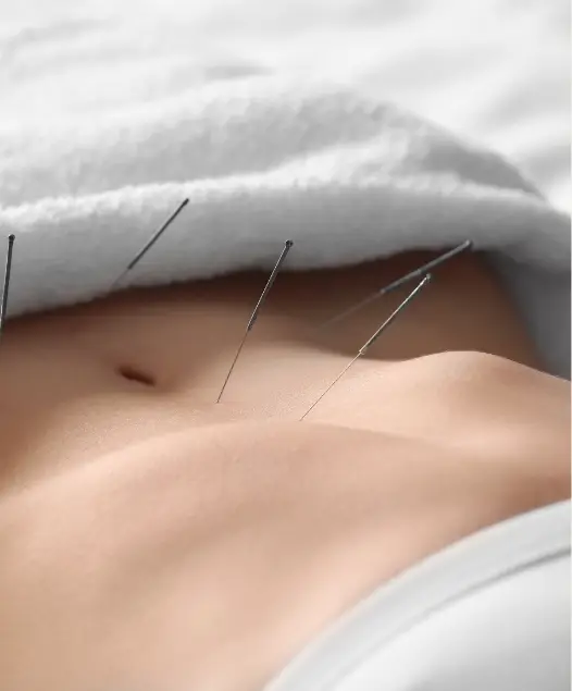 Acupuncture Victoria